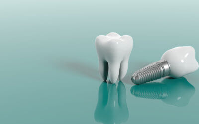 The Benefits of Getting Dental Implants in Greensboro, NC