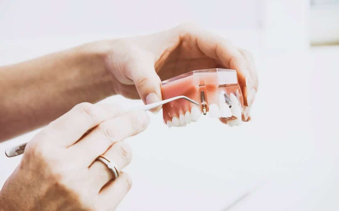 Everything to Know About Denture Implants