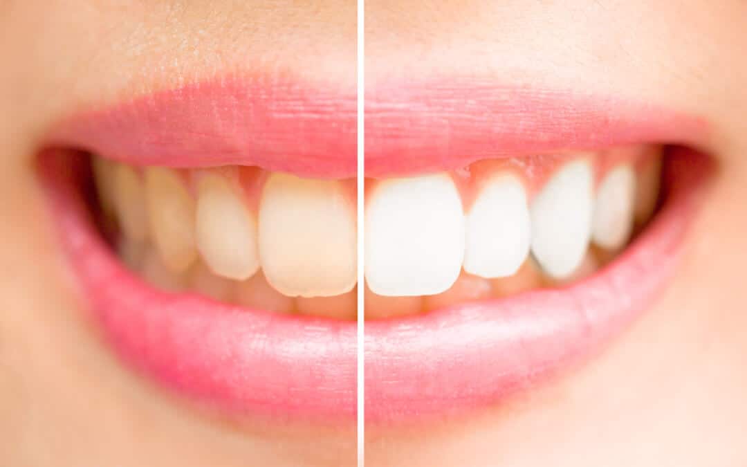 A Complete Guide on How to Whiten Teeth