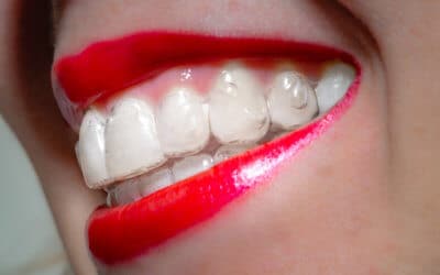 Invisalign Before and After: 6 Things You Should Know