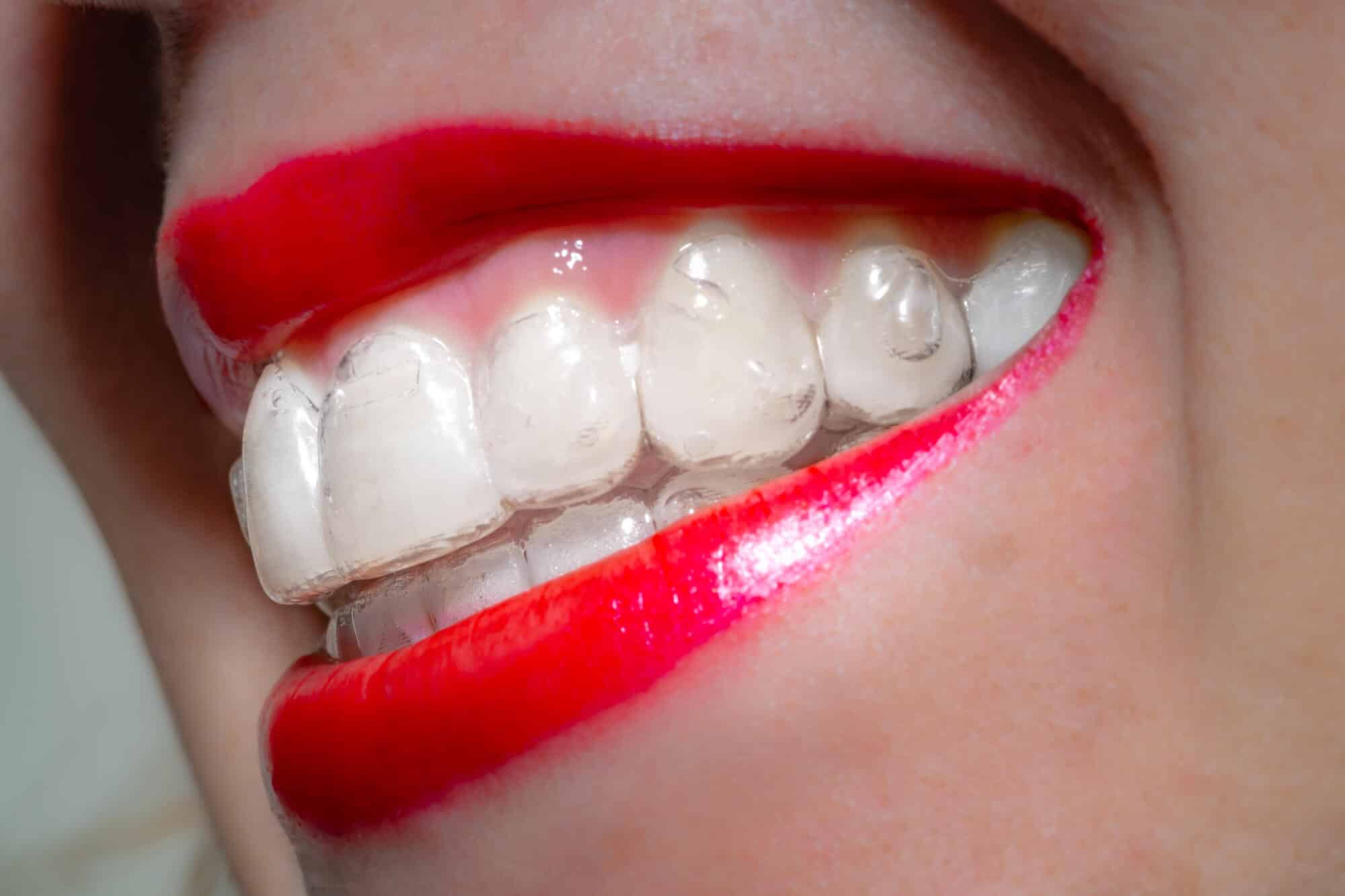 Invisalign Before and After: 6 Things You Should Know - Carolina Smiles