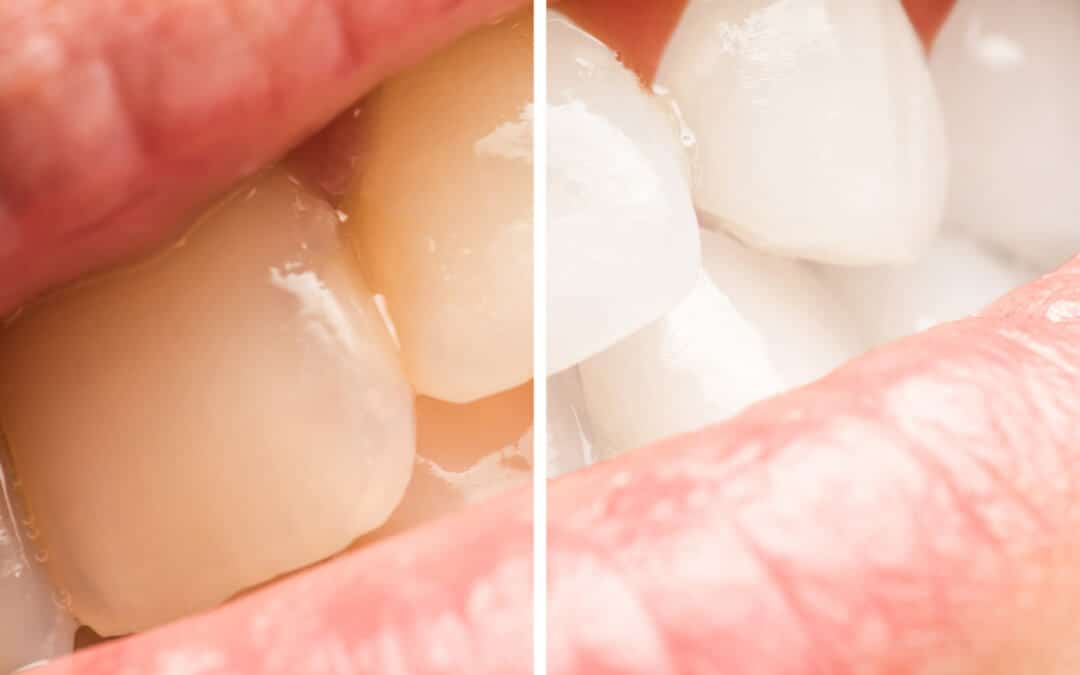 teeth discoloration