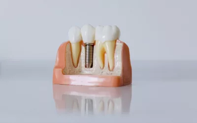 7 Dental Implant Maintenance Errors and How to Avoid Them
