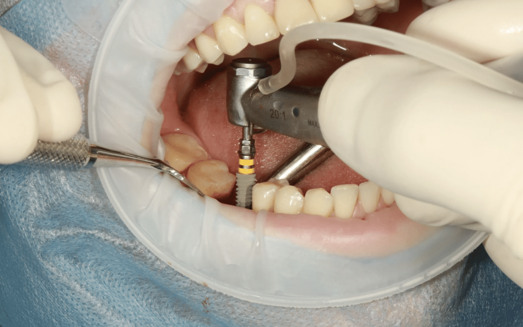 dental implant surgery recovery