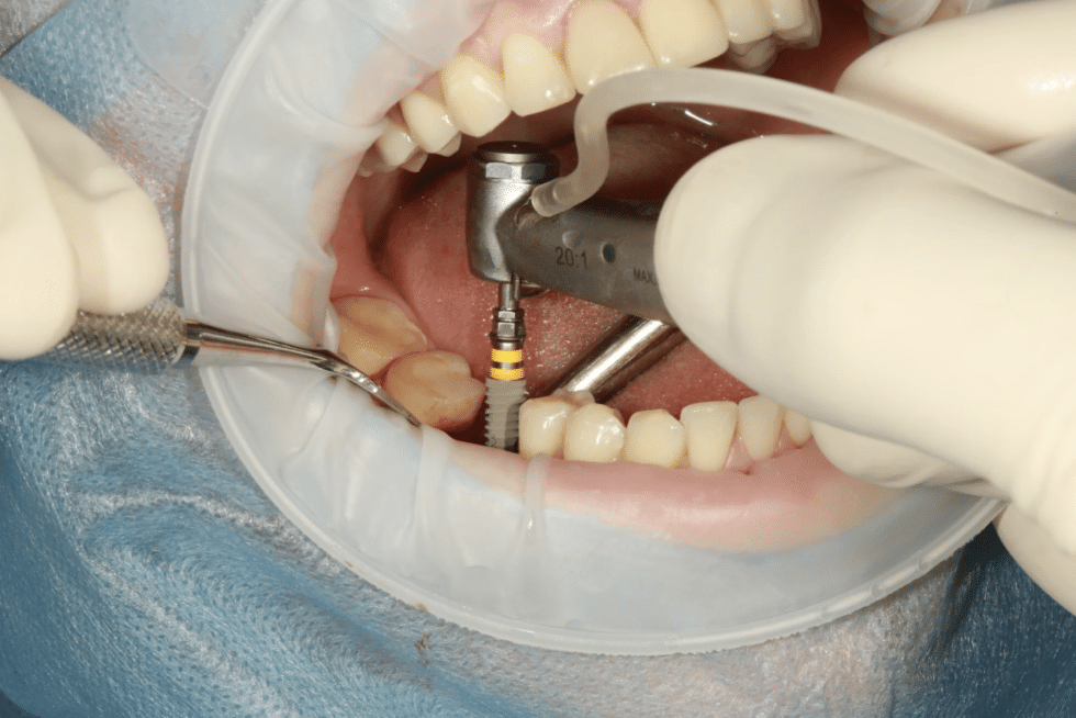 What to Expect From Dental Implant Surgery Recovery Time Carolina Smiles