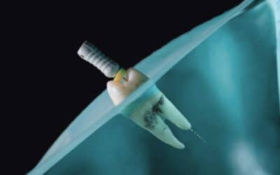 Can Dental Implants Get Infected?